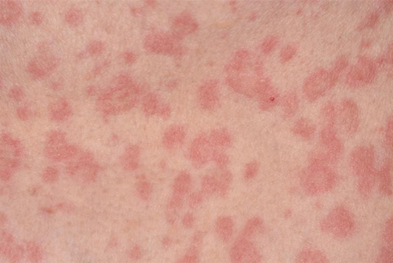 Rashes occur when exposed to cold air if someone has this allergy.